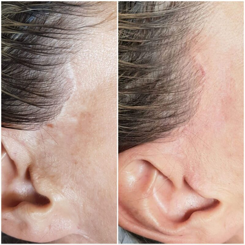 Inkless Scar & Stretch Mark Treatment Training